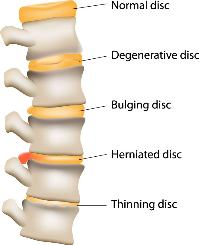bulging vs herniated disc