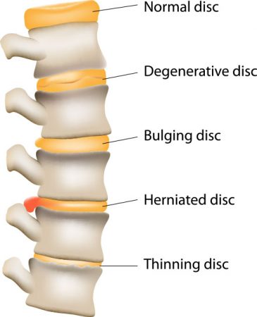 flexion distraction treats spinal disc disorders