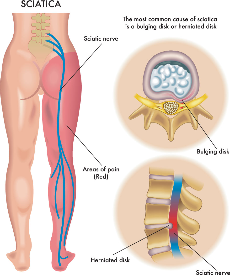 sciatica-causes causes of sciatica