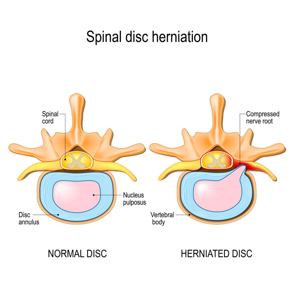 diagram of a herniated disc