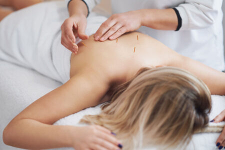 acupuncture being performed on a woman's back