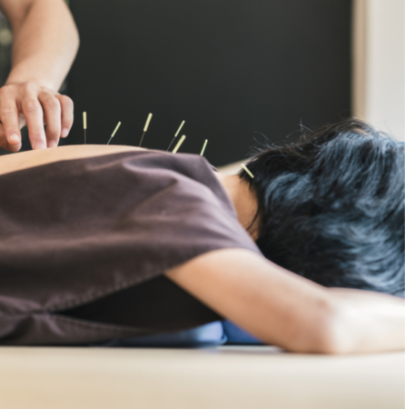woman getting accupuncture