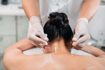 Chiropractor doing acupuncture on patient