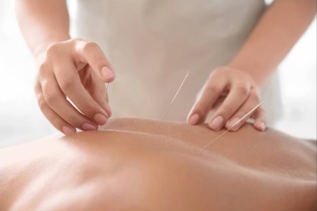 Clinician applying acupuncture needles to a patient's back