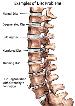 Illustration of various spine issues
