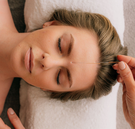 woman getting acupuncture